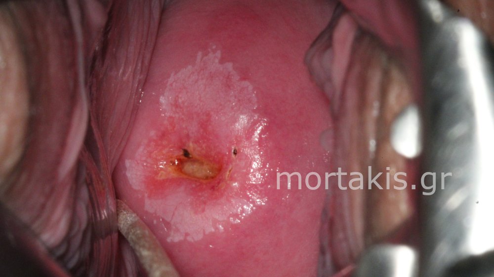 CIN1 LSIL CERVIX - Χαμηλού βαθμού αλλοίωσεις τραχήλου μήτρας