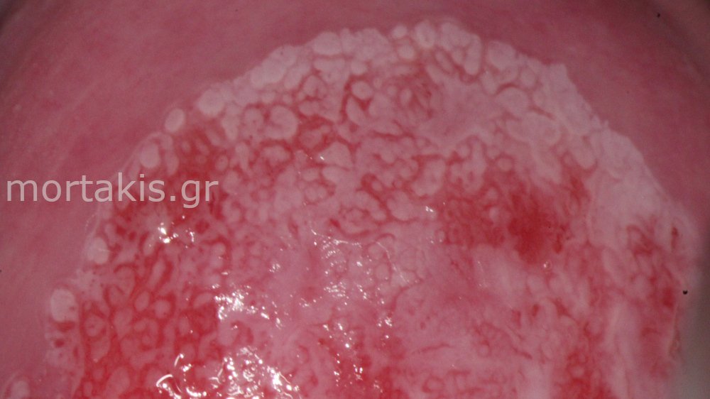 CIN1 LSIL CERVIX - Χαμηλού βαθμού αλλοίωσεις τραχήλου μήτρας