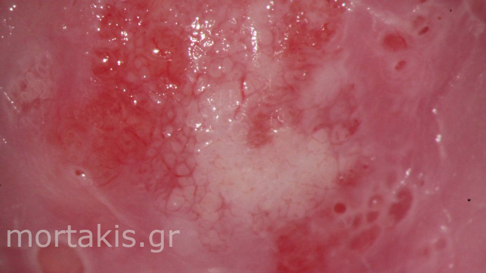 CIN1 LSIL CERVIX - Χαμηλού βαθμού αλλοίωσεις τραχήλου μήτρας