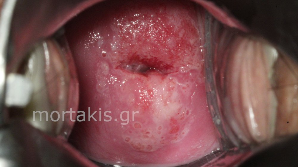 CIN1 LSIL CERVIX - Χαμηλού βαθμού αλλοίωσεις τραχήλου μήτρας