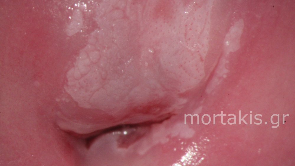 CIN1 LSIL CERVIX - Χαμηλού βαθμού αλλοίωσεις τραχήλου μήτρας