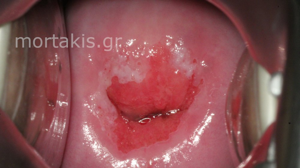 CIN1 LSIL CERVIX - Χαμηλού βαθμού αλλοίωσεις τραχήλου μήτρας