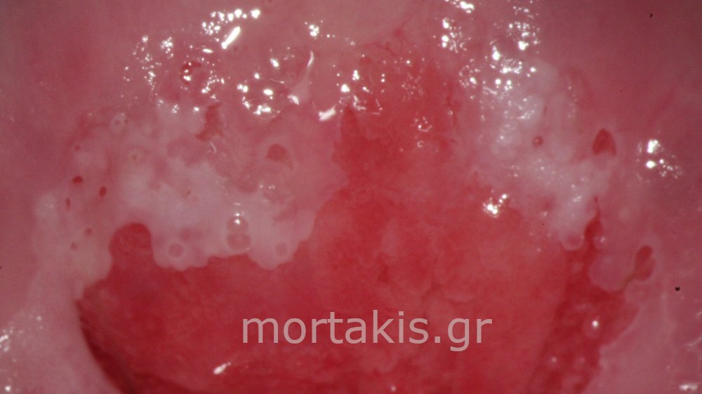 CIN1 LSIL CERVIX - Χαμηλού βαθμού αλλοίωσεις τραχήλου μήτρας