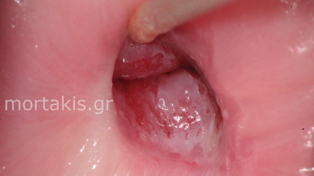 CIN1 LSIL CERVIX - Χαμηλού βαθμού αλλοίωσεις τραχήλου μήτρας