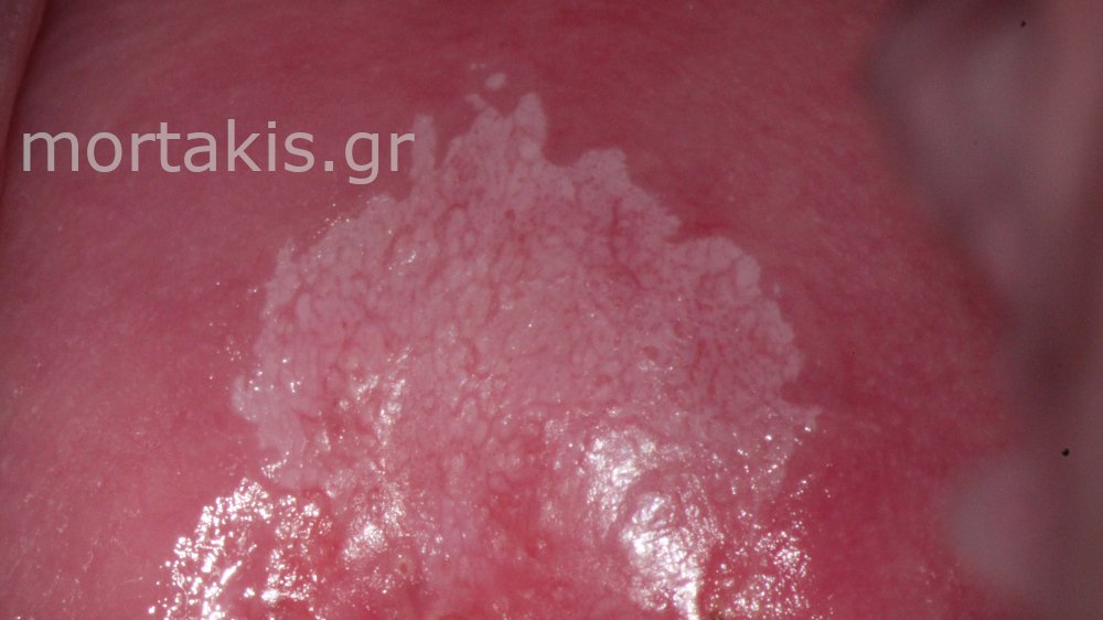 CIN1 LSIL CERVIX - Χαμηλού βαθμού αλλοίωσεις τραχήλου μήτρας