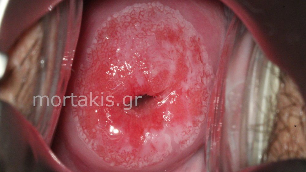 CIN1 LSIL CERVIX - Χαμηλού βαθμού αλλοίωσεις τραχήλου μήτρας