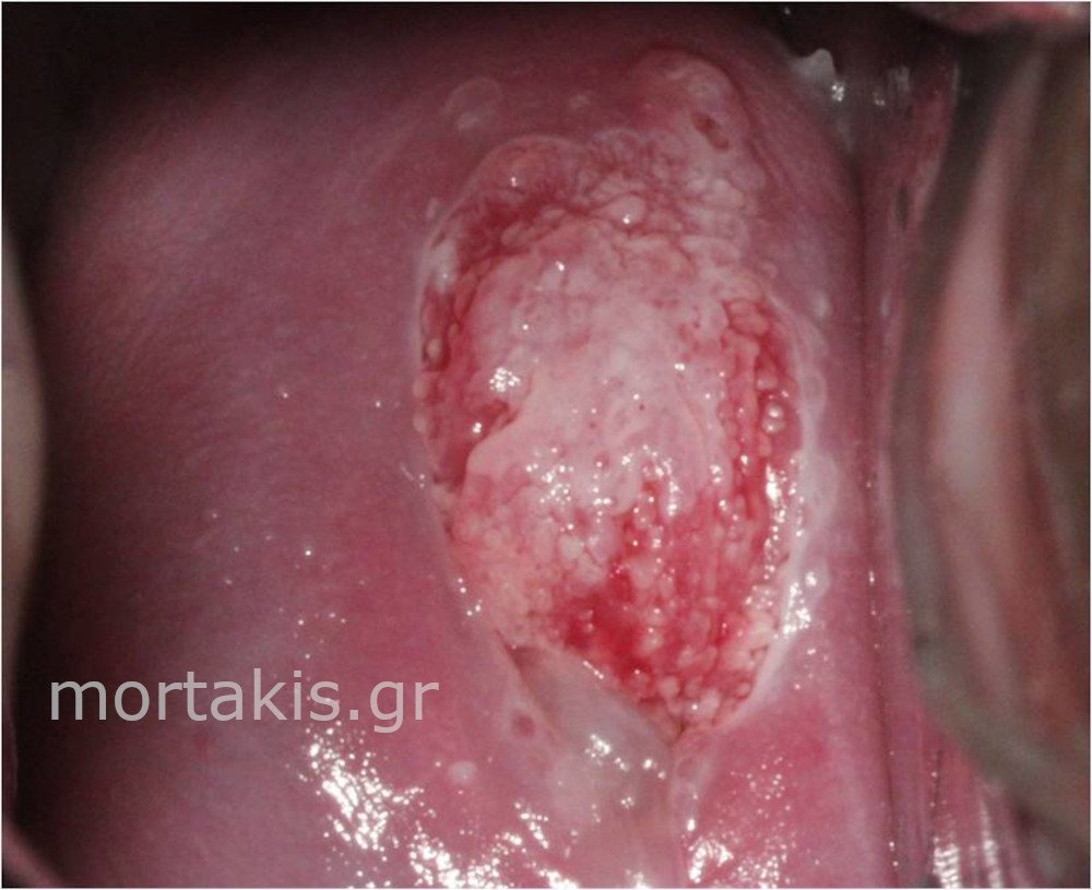 CIN2 PREGNANCY - Εγκυμοσύνη