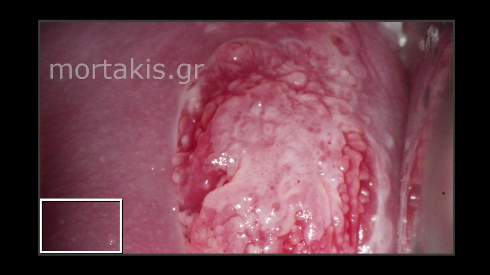 CIN2 PREGNANCY - Εγκυμοσύνη