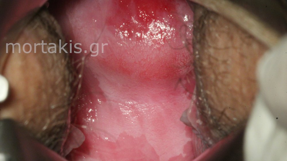 CONGENITAL TRANSFORMATION ZONE - Συγγενής ζώνη μετάπλασης