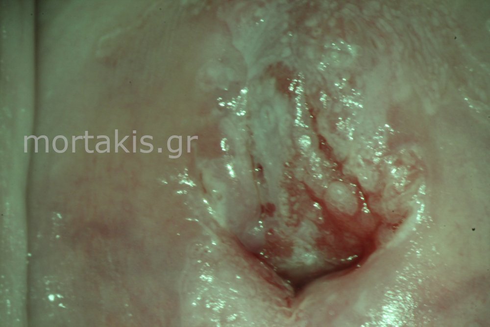 HSIL OF CERVIX - Υψηλού βαθμού αλλοιώσεις τραχήλου