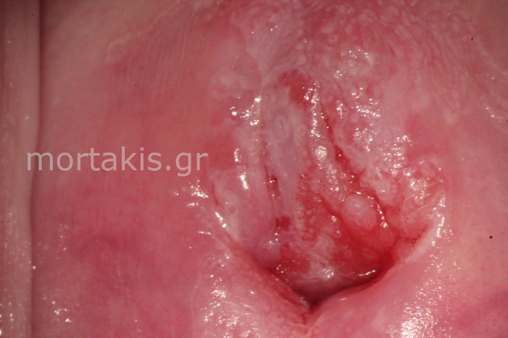 HSIL OF CERVIX - Υψηλού βαθμού αλλοιώσεις τραχήλου