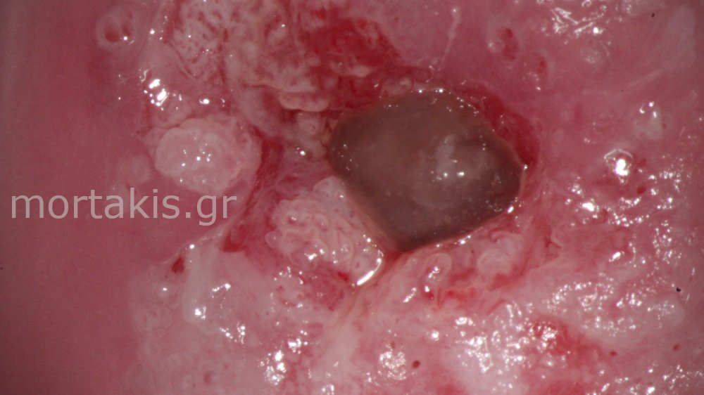 HSIL OF CERVIX - Υψηλού βαθμού αλλοιώσεις τραχήλου