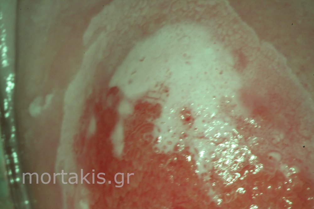 HSIL OF CERVIX - Υψηλού βαθμού αλλοιώσεις τραχήλου