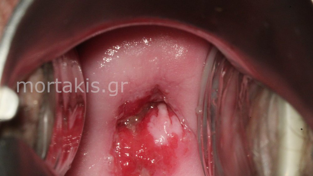 HSIL OF CERVIX - Υψηλού βαθμού αλλοιώσεις τραχήλου