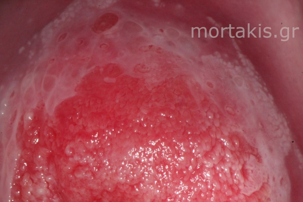 METAPLASIA CERVICAL - Μετάπλαση τραχήλου