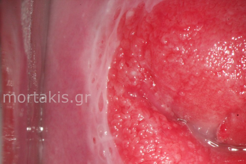 METAPLASIA CERVICAL - Μετάπλαση τραχήλου