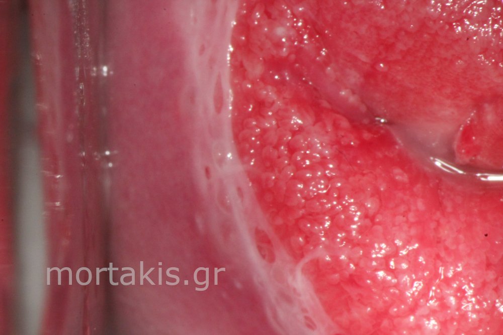 METAPLASIA CERVICAL - Μετάπλαση τραχήλου