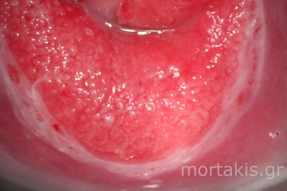 METAPLASIA CERVICAL - Μετάπλαση τραχήλου