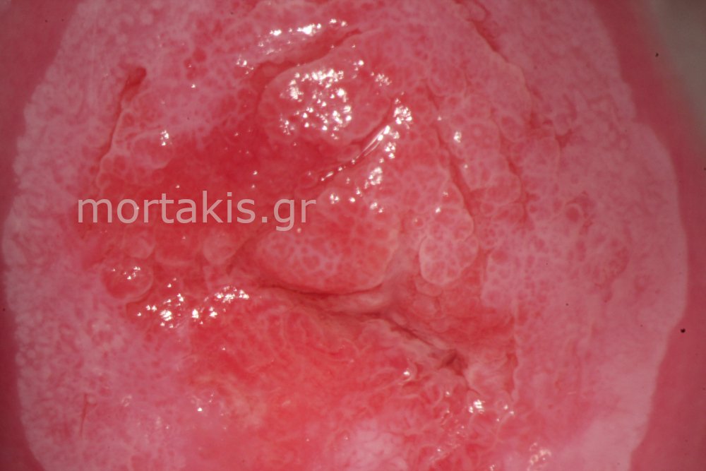METAPLASIA CERVICAL - Μετάπλαση τραχήλου