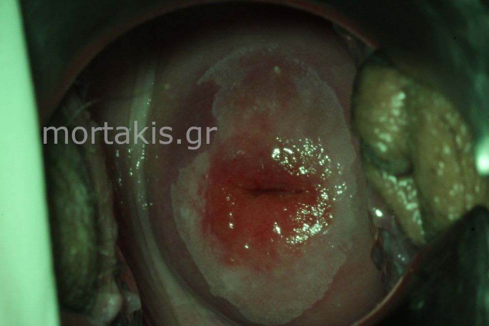 METAPLASIA CERVICAL - Μετάπλαση τραχήλου