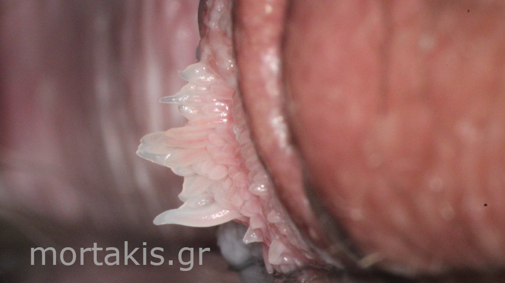 MICROPAPILLOMATOSIS VULVA - Μικροθηλωμάτωση