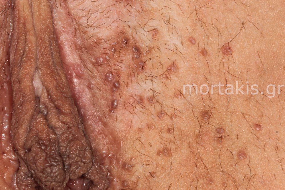 MOLLUSCUM CONTAGIOSUM - Μολυσματική τέρμινθος