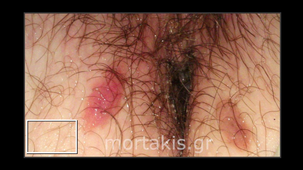 NAEVUS OF DERMIS VULVA - Χωριακός σπίλος