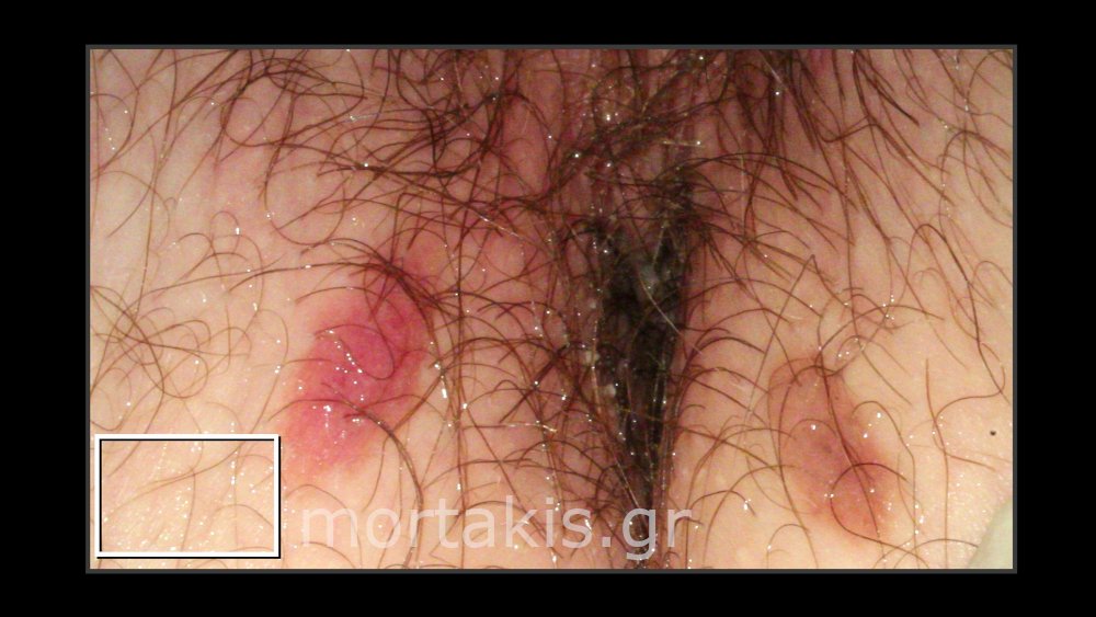 NAEVUS OF DERMIS VULVA - Χωριακός σπίλος