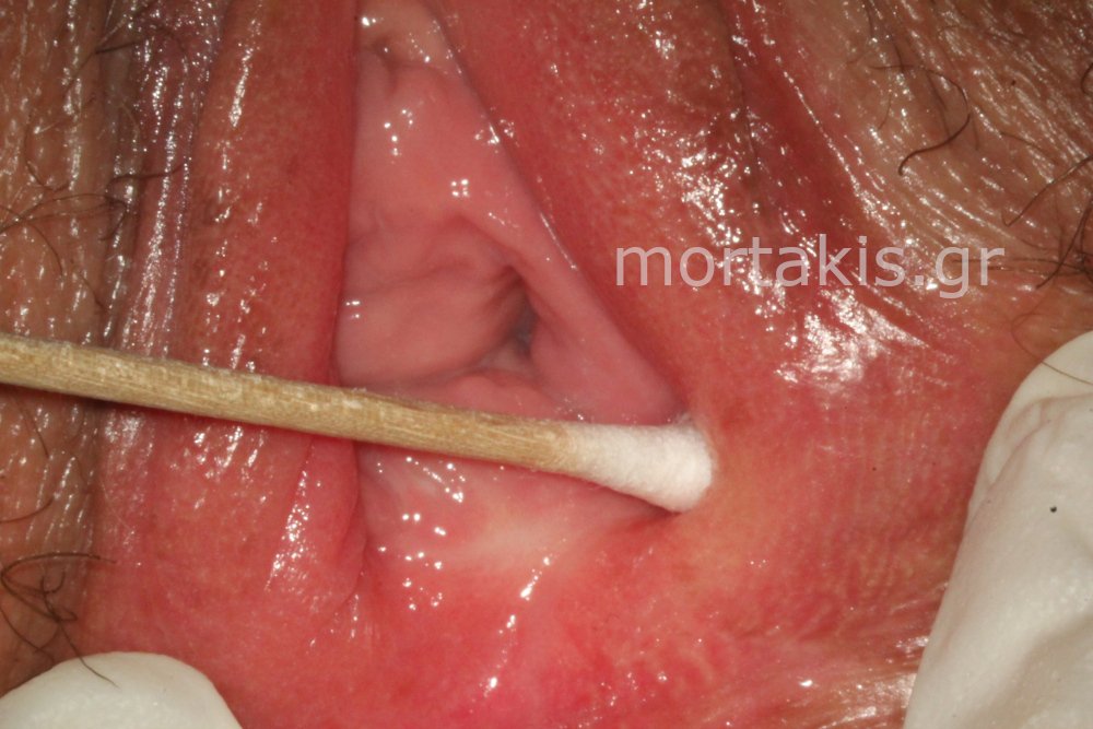 Q tip Test