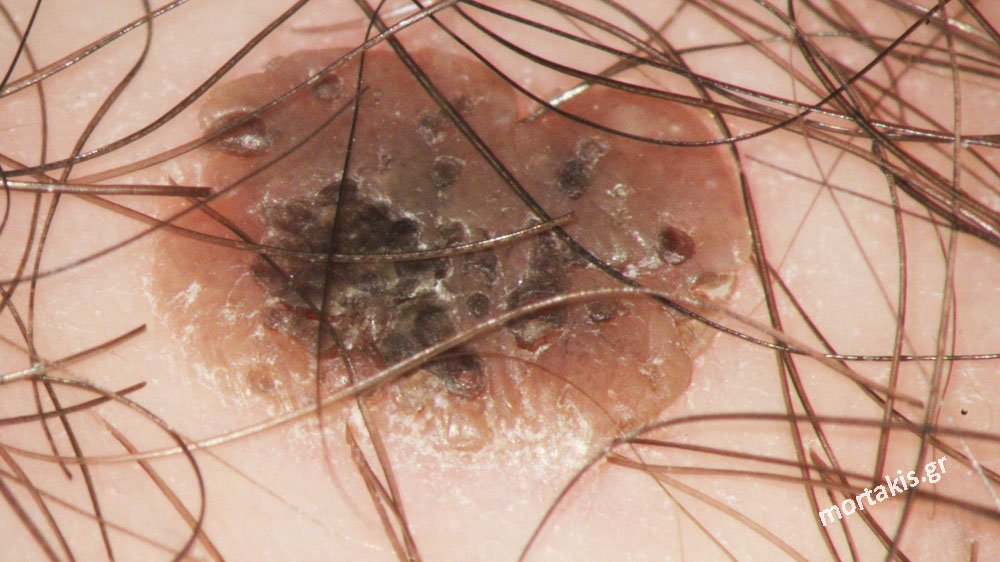 SEBBOERHEIC KERATOSIS VULVA - Σμηγματορροική κεράτωση