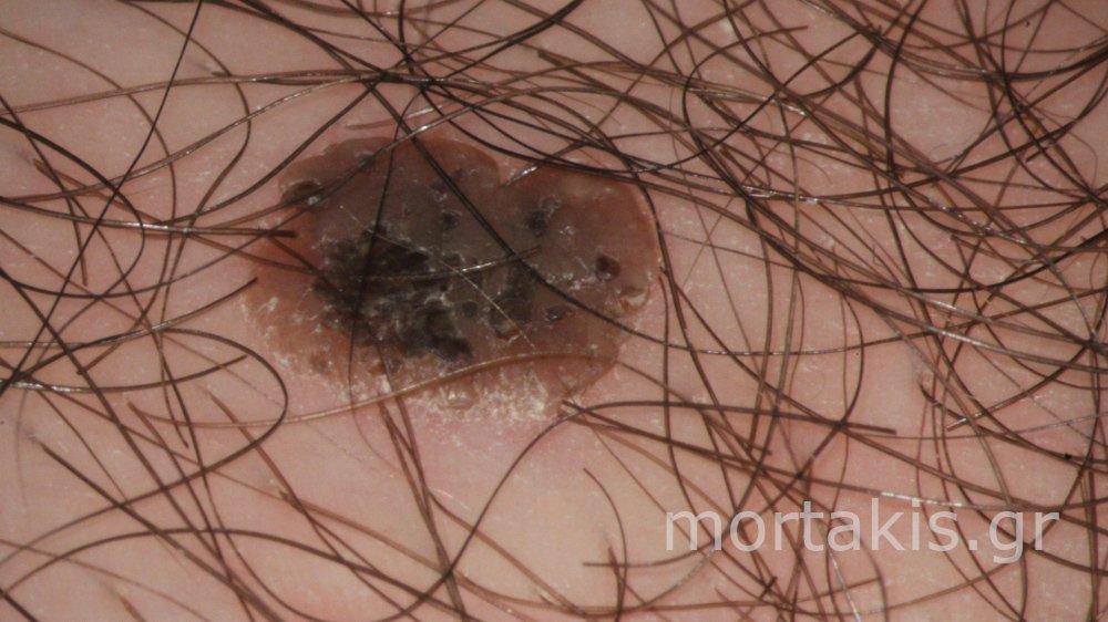 SEBBOERHEIC KERATOSIS VULVA - Σμηγματορροική κεράτωση