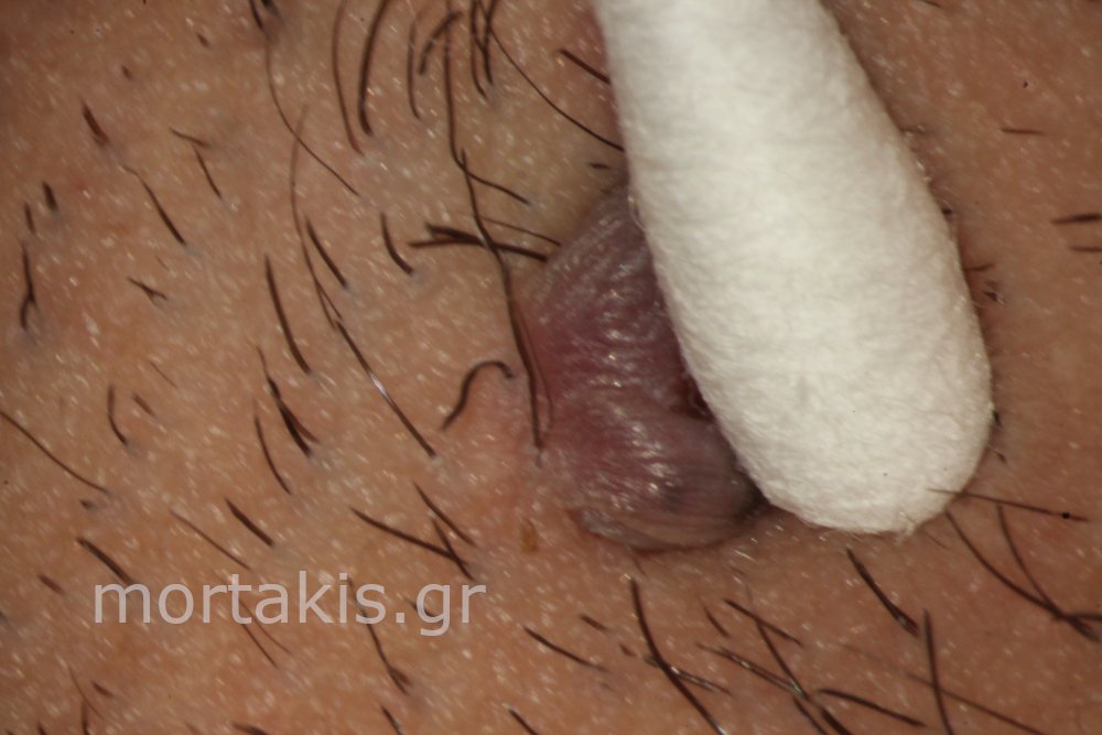 SKIN TAGS VULVA - Ακροχώρδονες