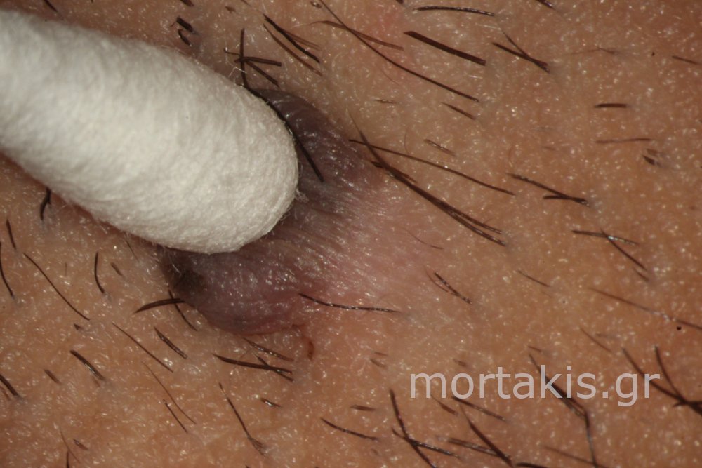 SKIN TAGS VULVA - Ακροχώρδονες