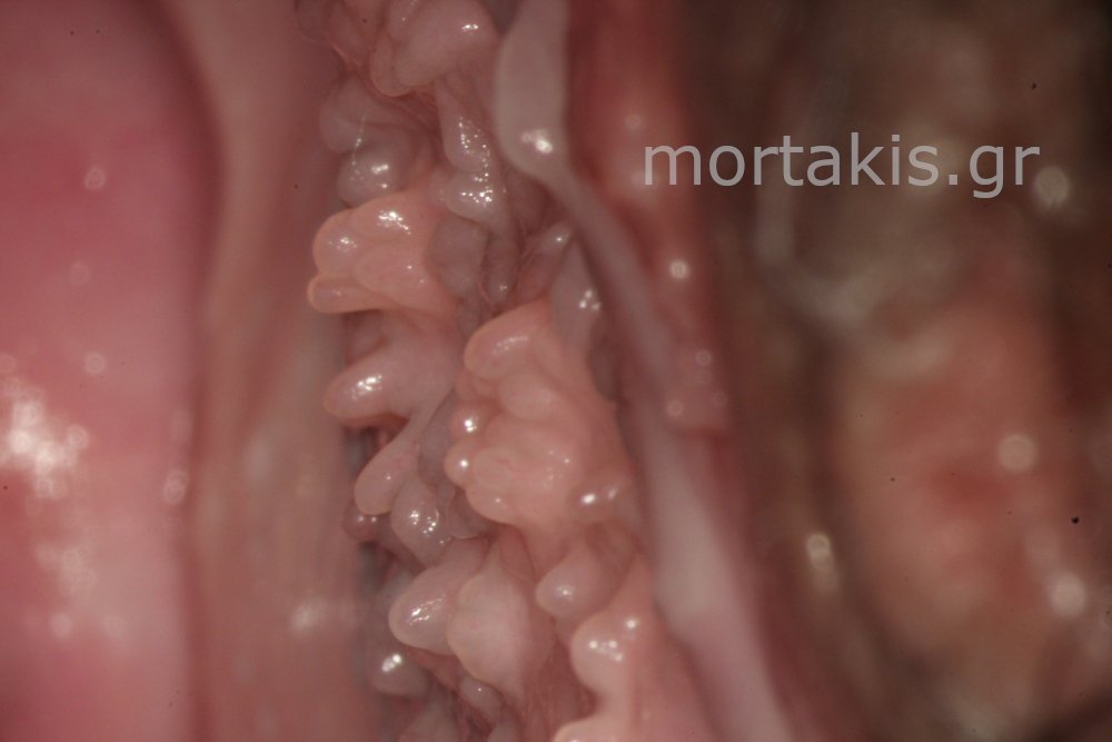 VAGINAL PAPPILAE - Θηλές κόλπου