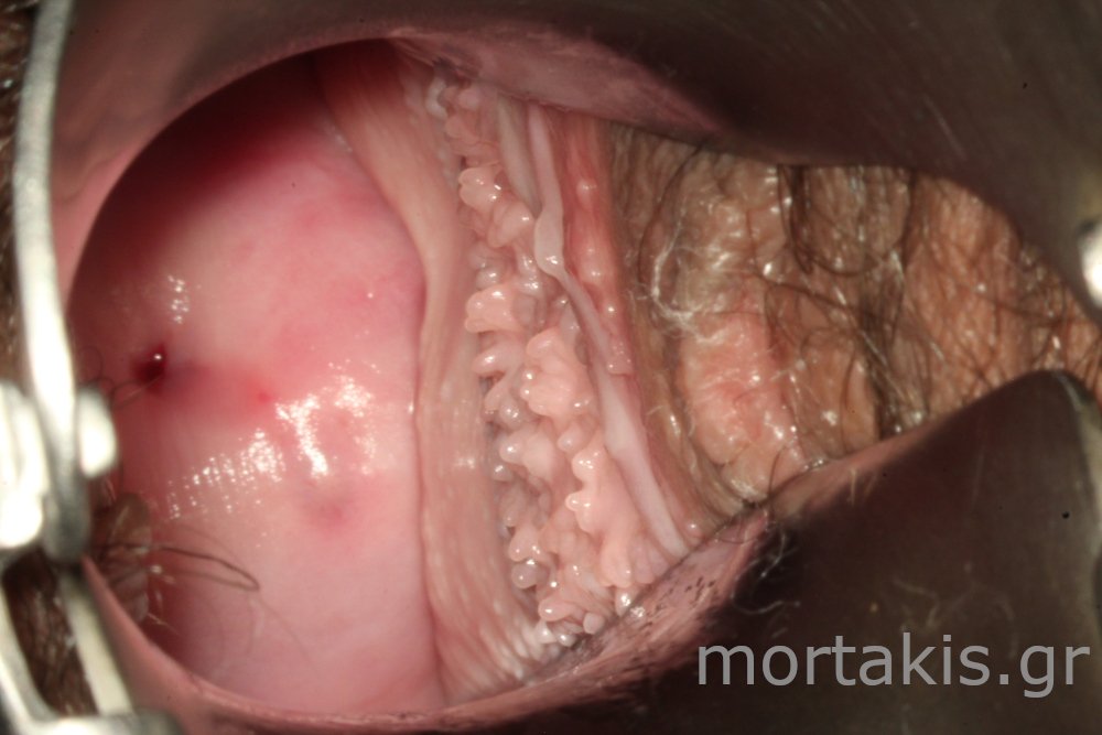 VAGINAL PAPPILAE - Θηλές κόλπου