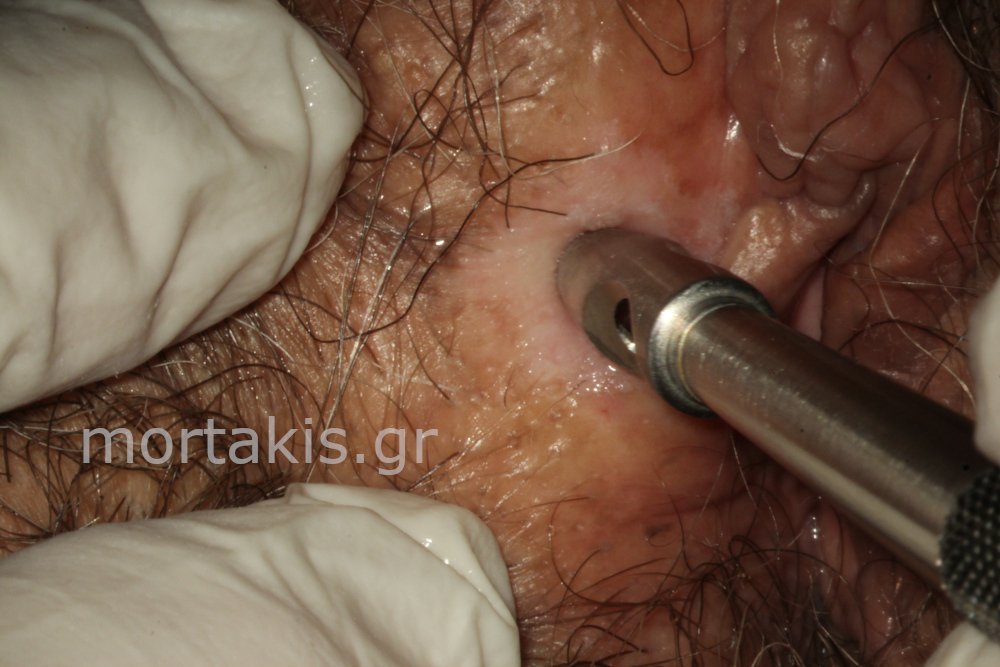 VULVAR BIOPSY - Βιοψία αιδοίου