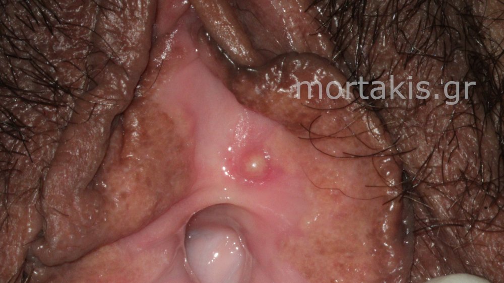 VULVAR CYSTS - Κύστεις αιδοίου