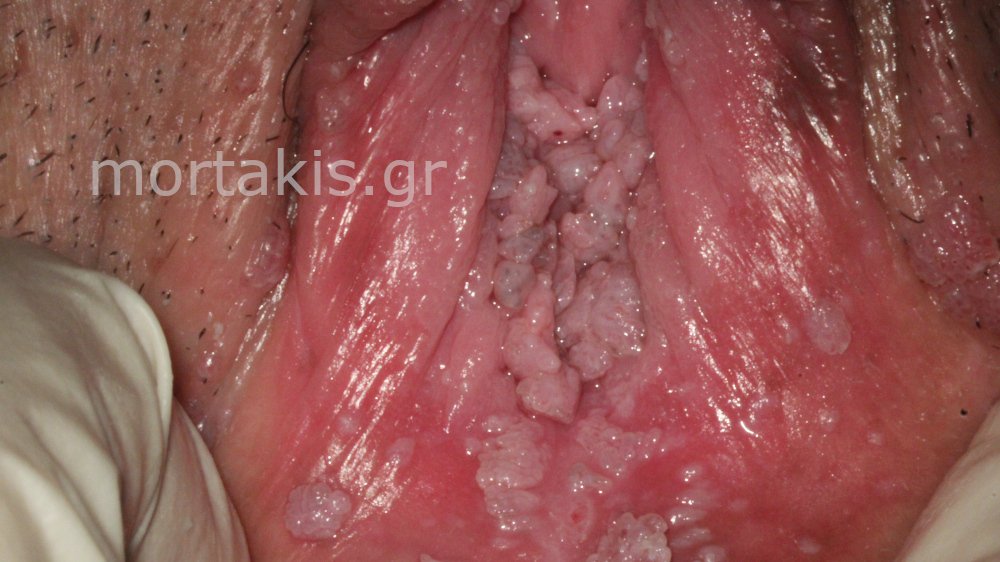 WARTS CONDYLOMAS - Κονδυλώματα