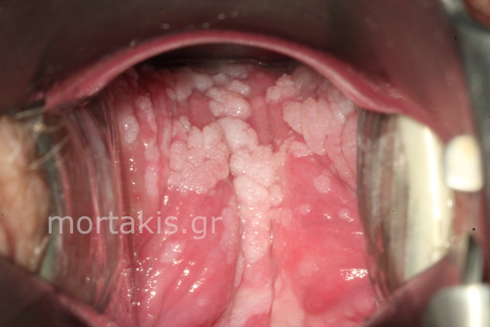 WARTS CONDYLOMAS - Κονδυλώματα