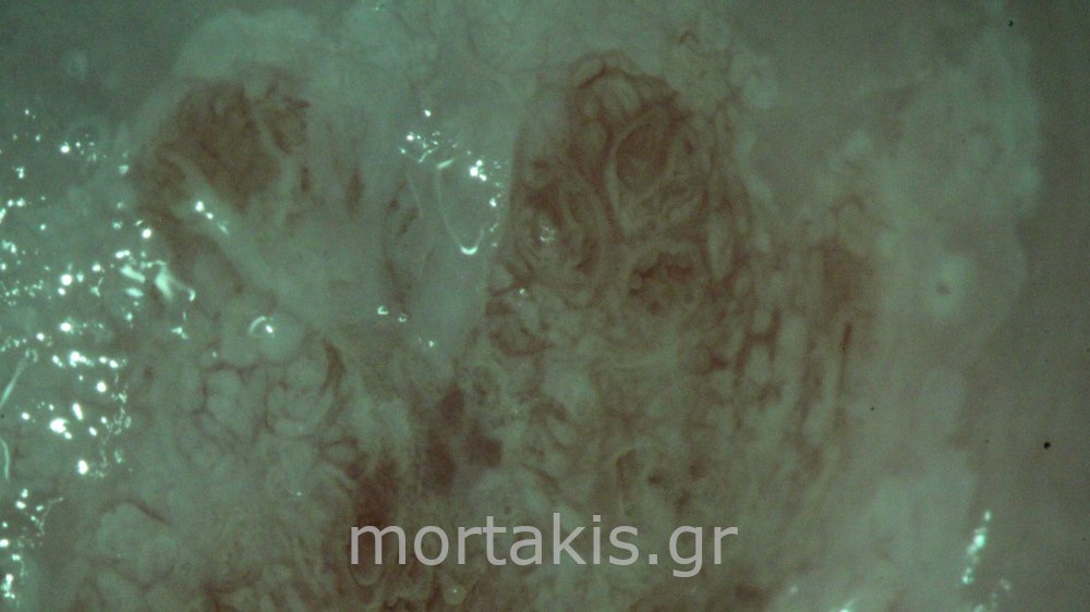 ADENOCARCINOMA IN SITU OF CERVIX - Αδενοκαρκίνωμα
