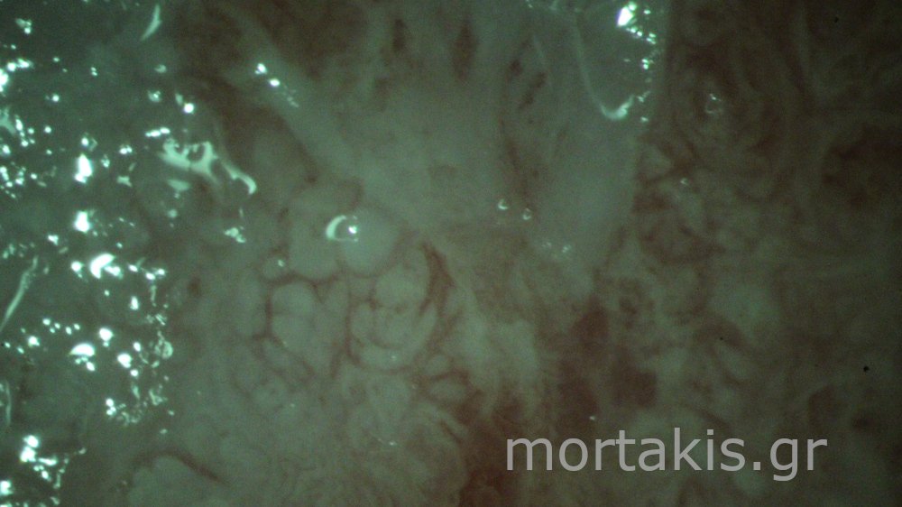 ADENOCARCINOMA IN SITU OF CERVIX - Αδενοκαρκίνωμα