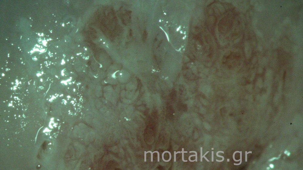 ADENOCARCINOMA IN SITU OF CERVIX - Αδενοκαρκίνωμα
