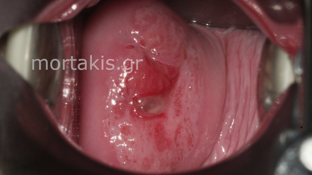 ADENOCARCINOMA IN SITU OF CERVIX - Αδενοκαρκίνωμα