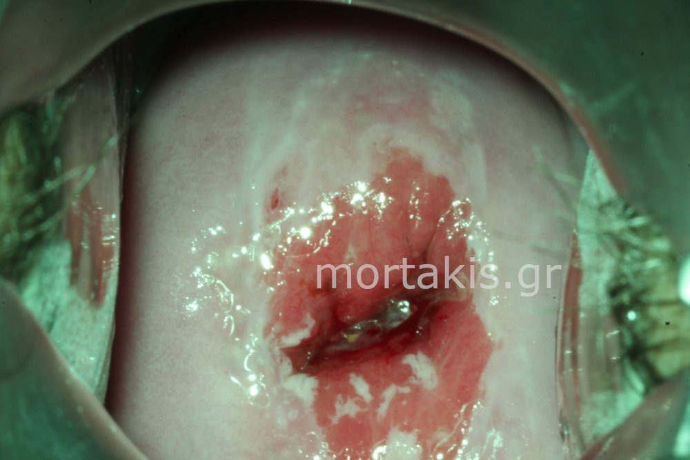 ADENOCARCINOMA IN SITU OF CERVIX - Αδενοκαρκίνωμα