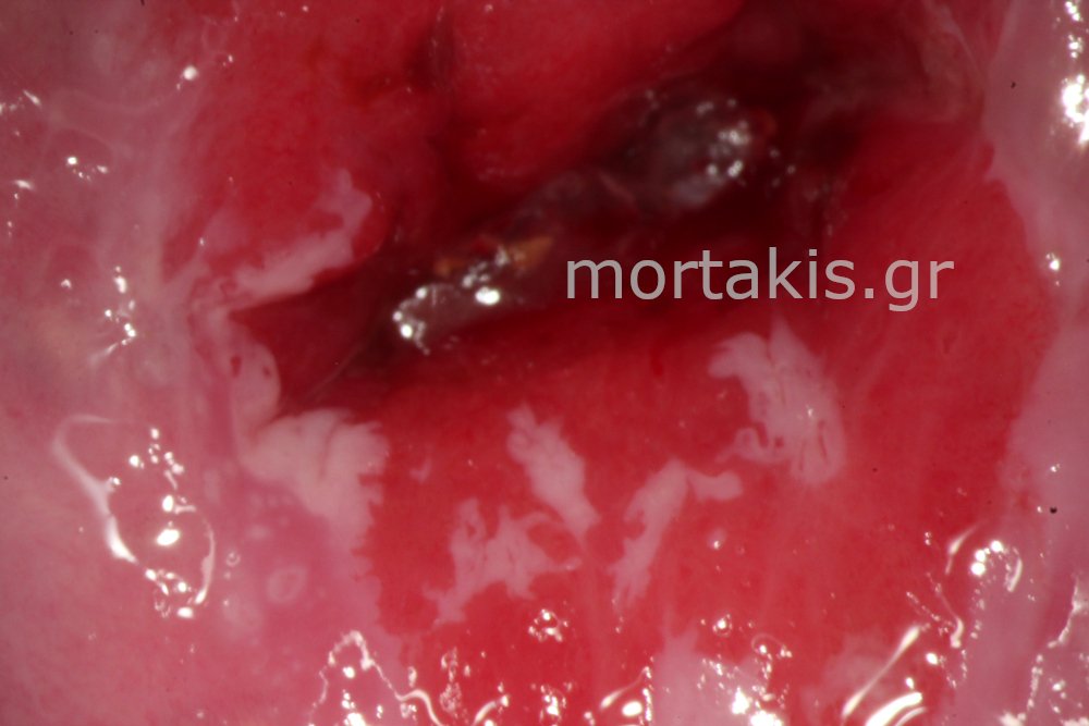 ADENOCARCINOMA IN SITU OF CERVIX - Αδενοκαρκίνωμα