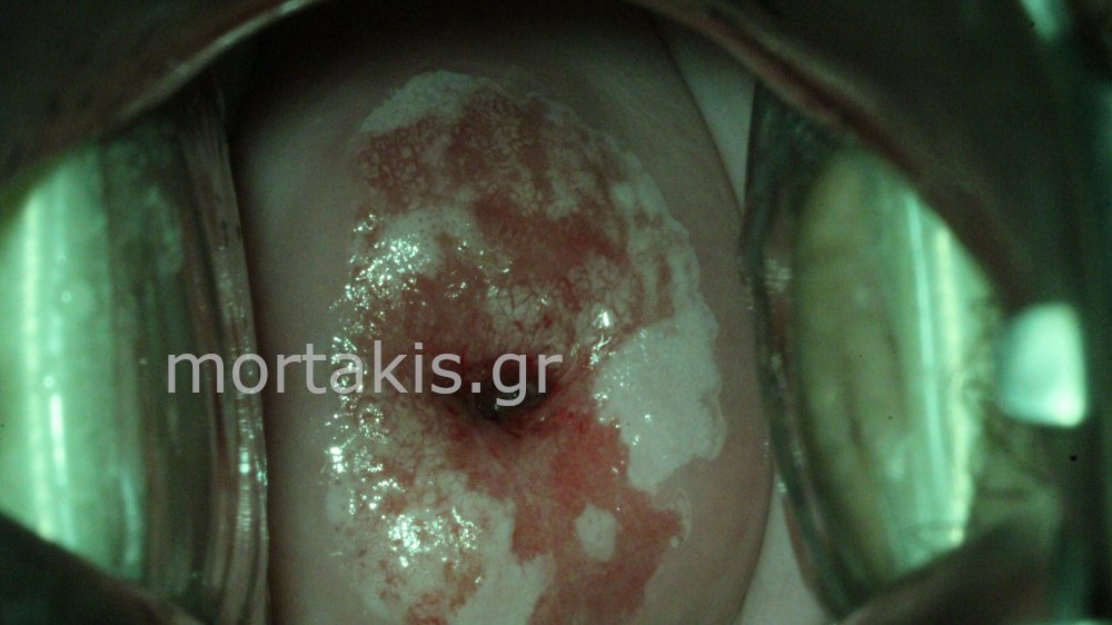 ADENOCARCINOMA IN SITU OF CERVIX - Αδενοκαρκίνωμα