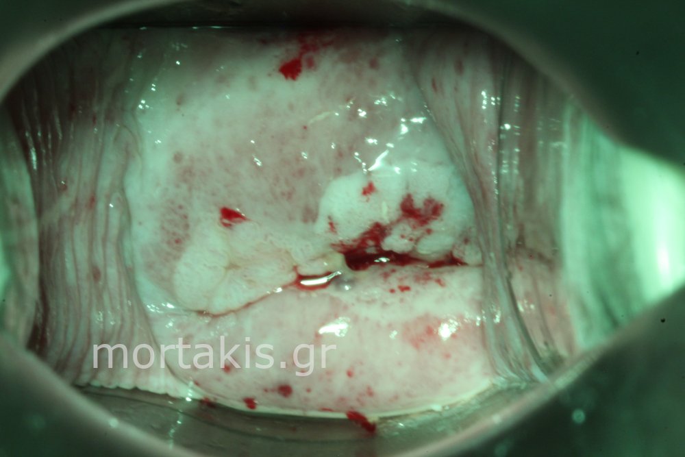 CERVICAL CANCER - Καρκίνος τραχήλου μήτρας