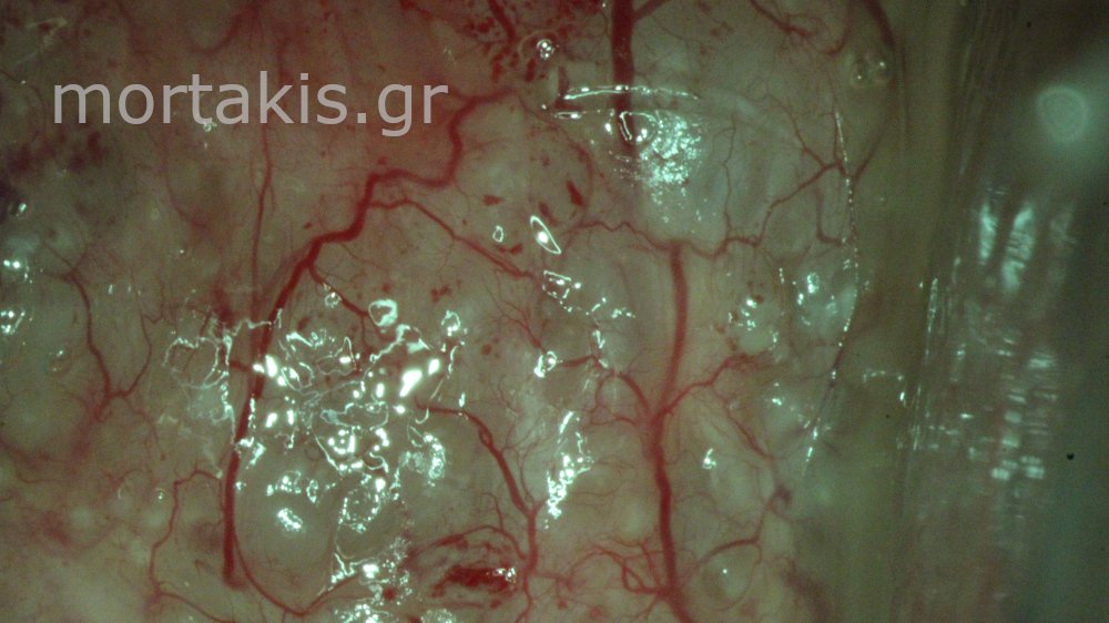 CERVICAL VESSELS - Αγγεία Τραχήλου Μήτρας