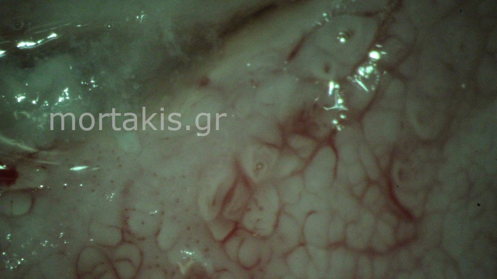 CERVICAL VESSELS - Αγγεία Τραχήλου Μήτρας