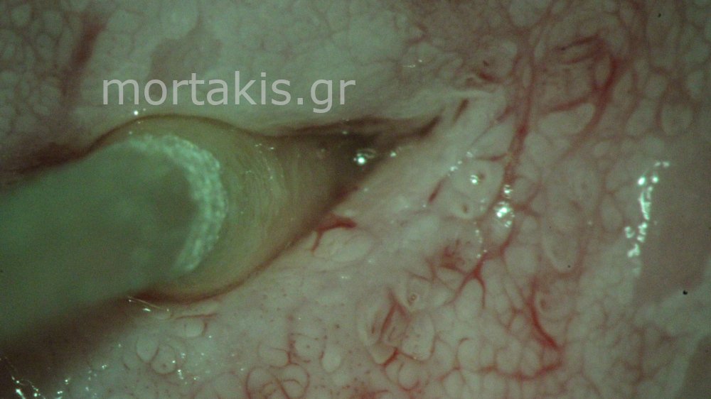 CERVICAL VESSELS - Αγγεία Τραχήλου Μήτρας